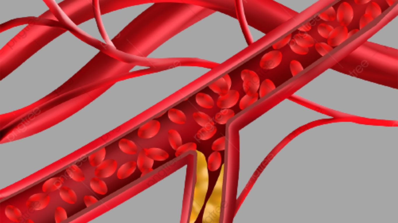 ATHEROMA_atheromatous_aorta_atheromatous_aorta_meaning