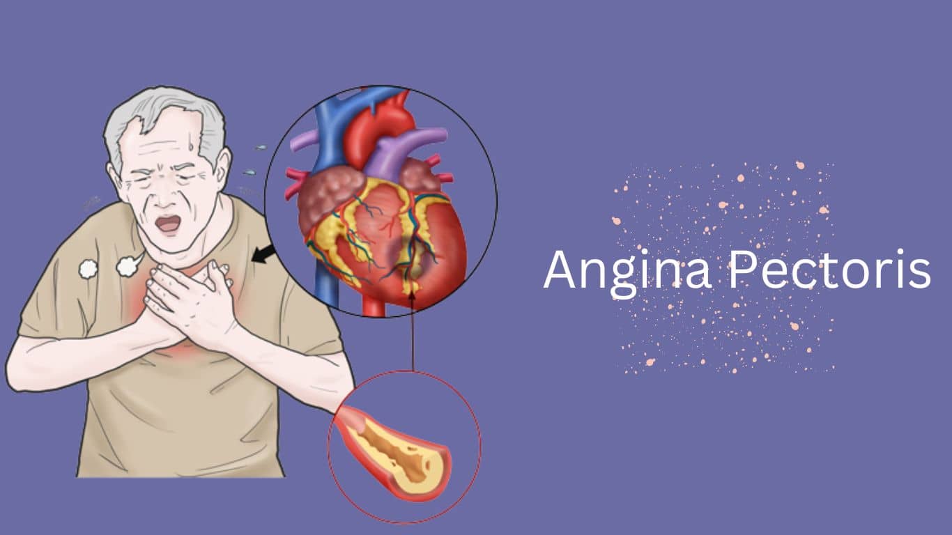 Angina_Pectoris