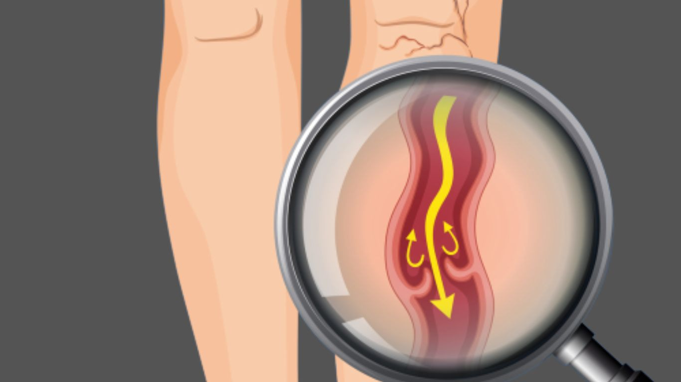 How_Does_Deep_Vein_Thrombophlebitis_Cause_Pulmonary_Embolism?