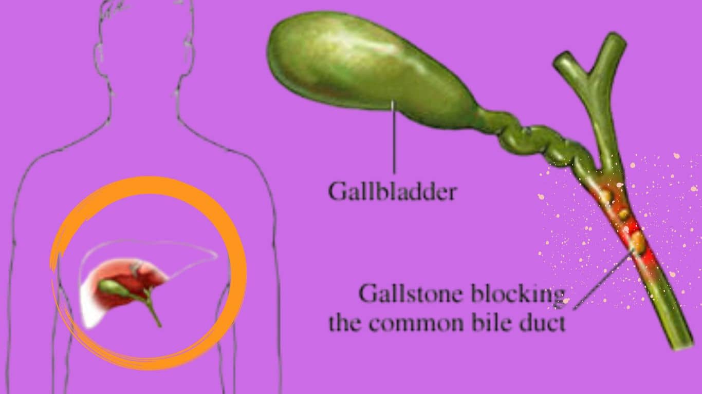 how-to-gall-bladder-stone-can-be-removed-without-surgery