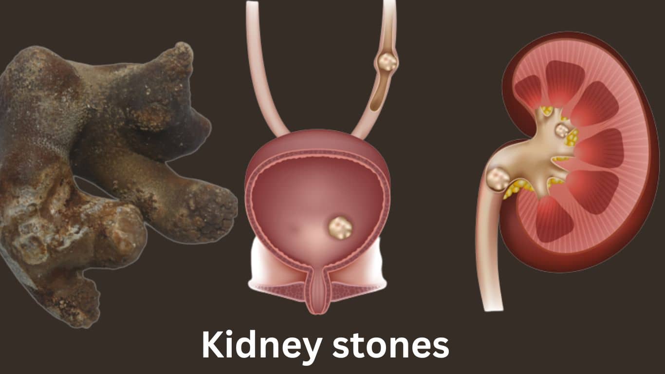 how-medications-are-helpful-for-kidney-stones-remove