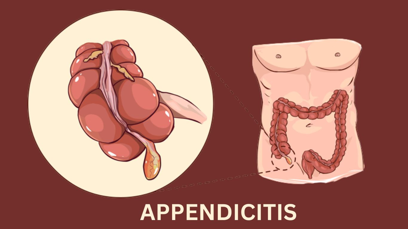 how-to-appendicitis-treatment-without-surgery-in-homeopathy