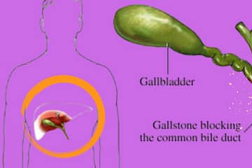 how-to-gall-bladder-stone-can-be-removed-without-surgery