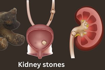 how-medications-are-helpful-for-kidney-stones-remove