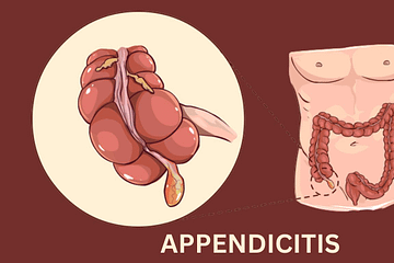 how-to-appendicitis-treatment-without-surgery-in-homeopathy