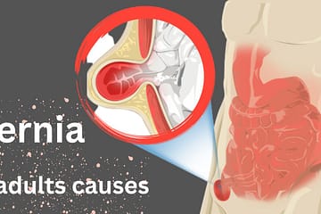 how-to-causes-and-symptoms-of-hernia-types-in-adults