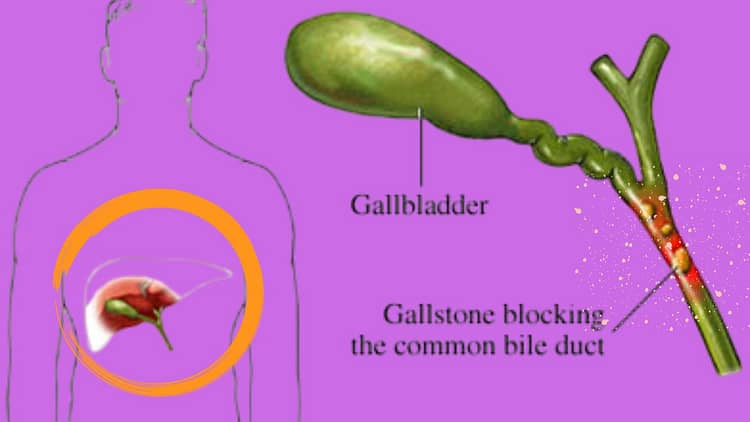 how-to-gall-bladder-stone-can-be-removed-without-surgery