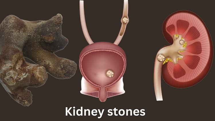 how-medications-are-helpful-for-kidney-stones-remove