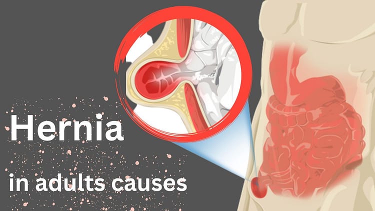 how-to-causes-and-symptoms-of-hernia-types-in-adults