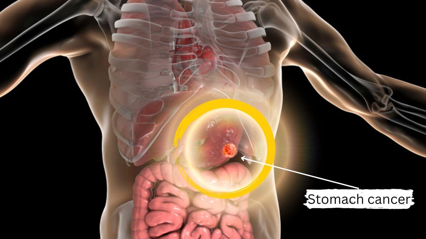 New Treatment for Stomach Cancer Define gastric tumor